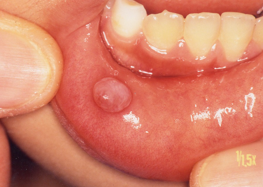 に 中 口 水疱 の 口の中にできた水ぶくれ。治し方は？