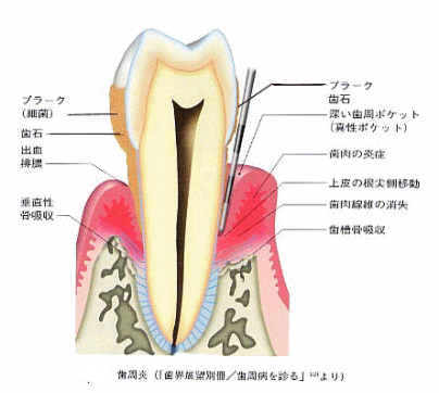 歯周病の概念